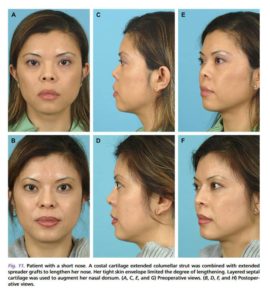 Toriumi D, Swartout BG. Rhinoplasty in the Asian Nose