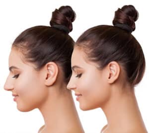 Toriumi D, Swartout BG. Nasal Tip Reconstruction