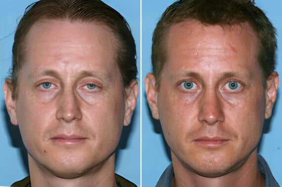 Rhinoplasty Before and After Photos in Beverly Hills, CA