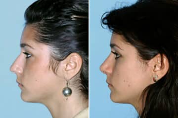 Rhinoplasty Before and After Photos in Beverly Hills, CA, Patient 191