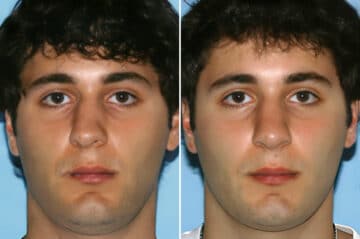 Rhinoplasty Before and After Photos in Beverly Hills, CA, Patient 195