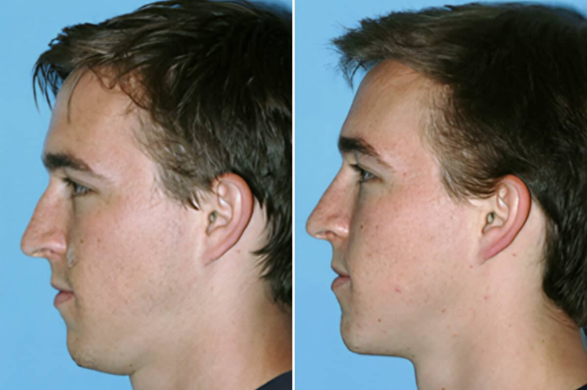 Rhinoplasty Before and After Photos in Beverly Hills, CA, Patient 199