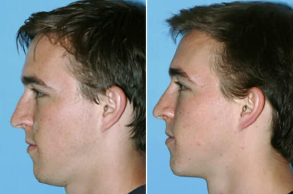 Rhinoplasty Before and After Photos in Beverly Hills, CA, Patient 199