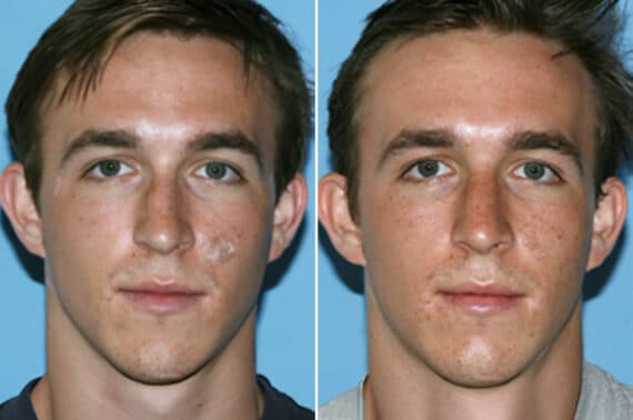 Rhinoplasty Before and After Photos in Beverly Hills, CA, Patient 199