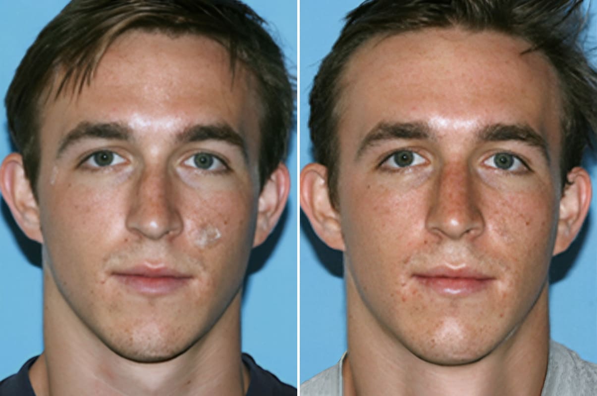 Runny Nose After Rhinoplasty Benjamin G Swartout M D 