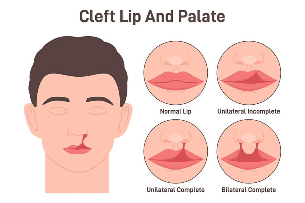 cleft lip and palate comparison