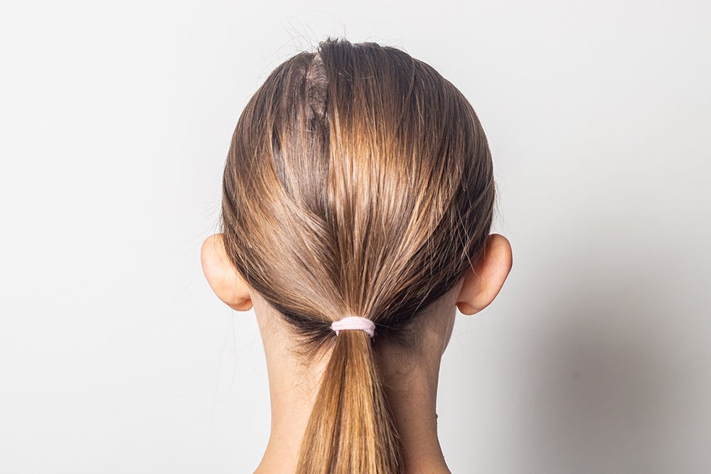 Adult patient with excess cartilage in the ears preparing herself for an ear-pinning surgery.