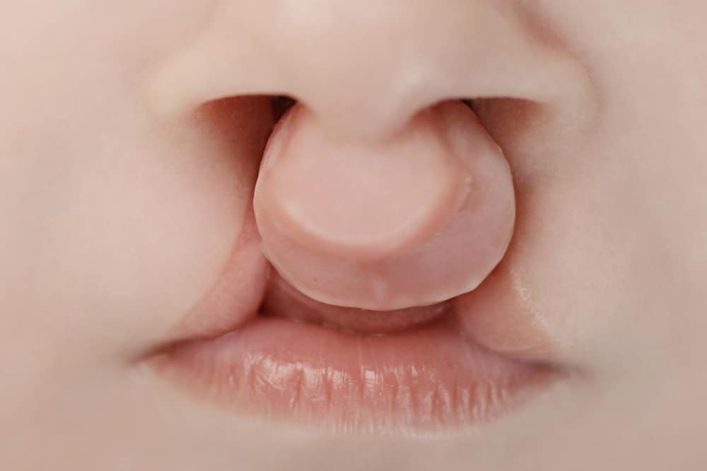Infant with cleft lip showing separation in upper lip and nasal base before surgical reconstruction for congenital defect.