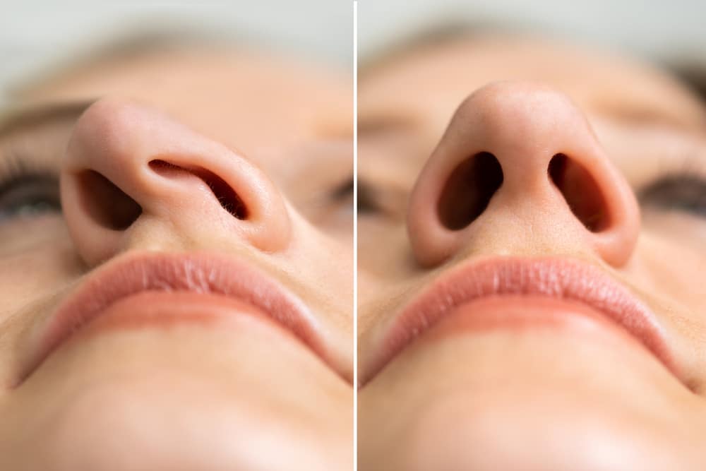 Close-up of nose before and after nasal reconstruction showing improved nostril symmetry and structure.