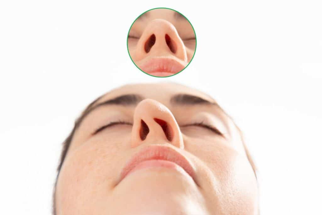 Close-up view of nostrils with inset focus on nasal shape, highlighting signs of healing before revision rhinoplasty.