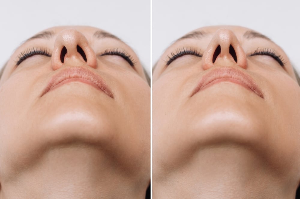 Close-up of a woman’s nose in before-and-after rhinoplasty comparison showing surgical refinement and symmetry.